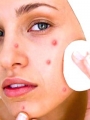 Pimples